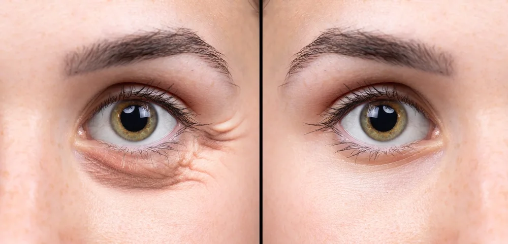 Treatment To Remove Eye Bags At Home Versus Clinic